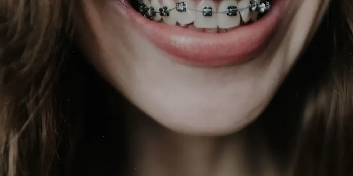 Sorriso com aparelho ortodôntico fixo, em close