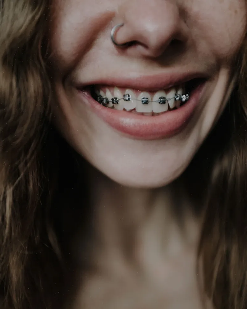 Sorriso com aparelho ortodôntico fixo, em close