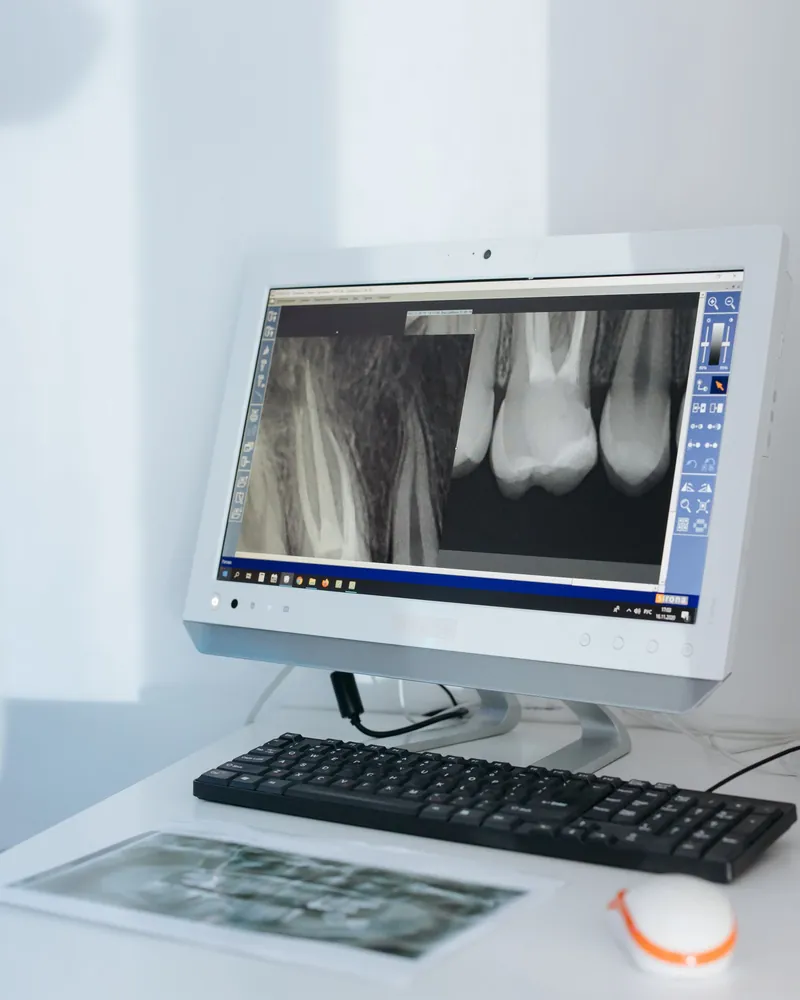 A radiografia de um dente aberta na tela do computador
